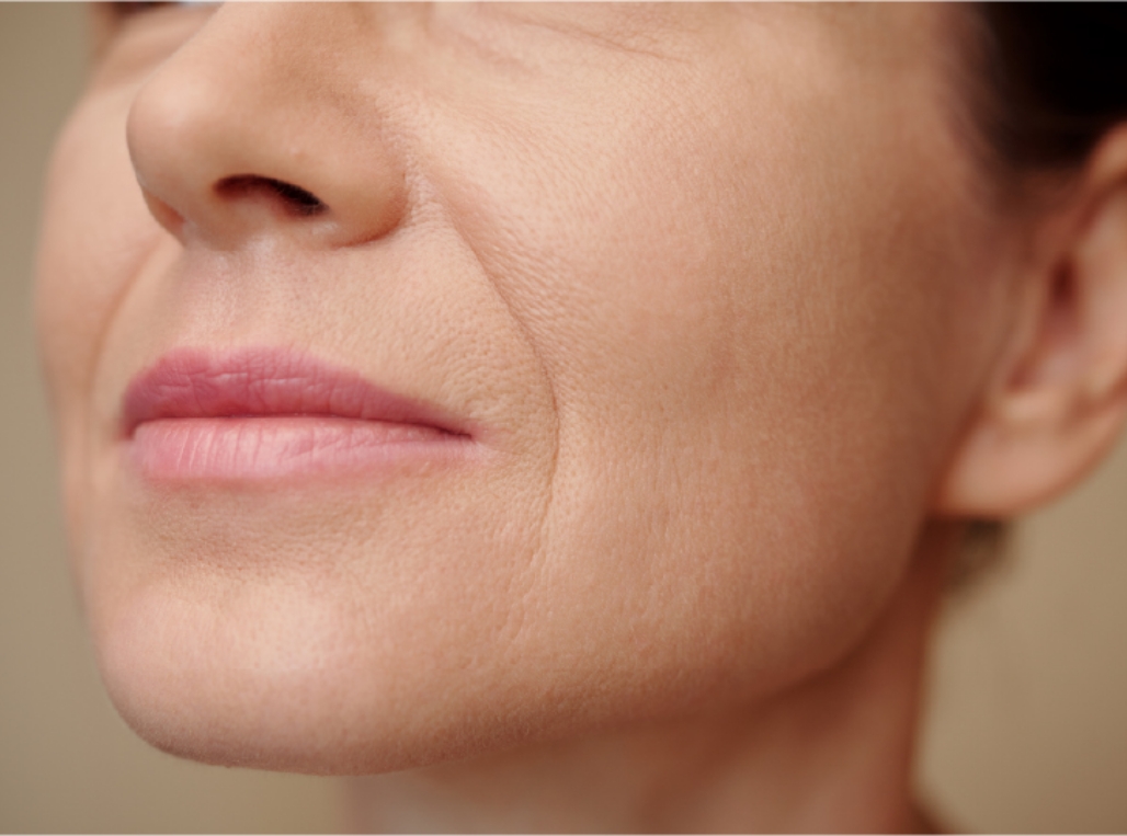 糸リフト（ミントリフト）